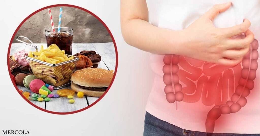 Unveiling the Link Between Ultraprocessed Foods and Colon Cancer