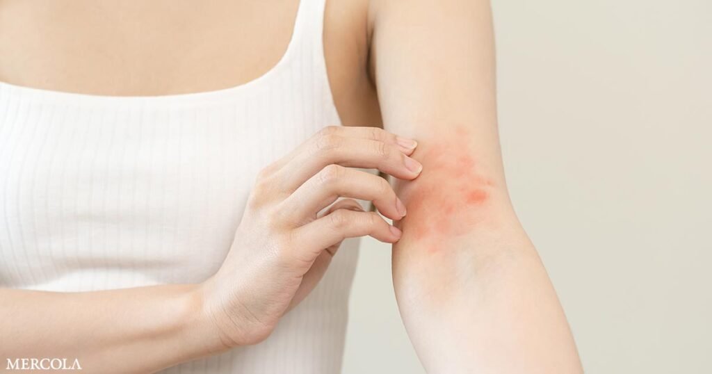 Atopic Dermatitis Linked to Higher Risk of Hyperparathyroidism