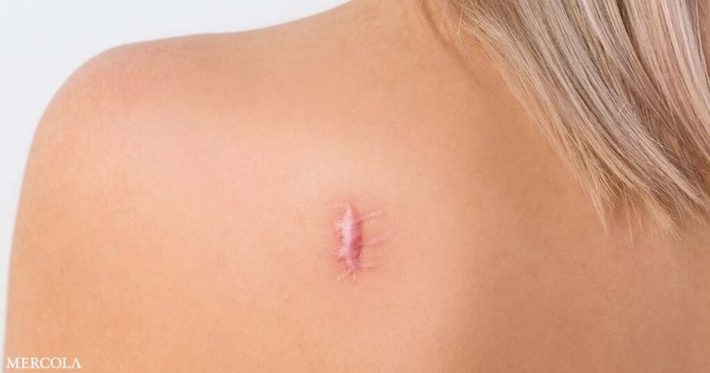 Targeting Vitamin D Pathways Helps Treat Wounds and Keloids