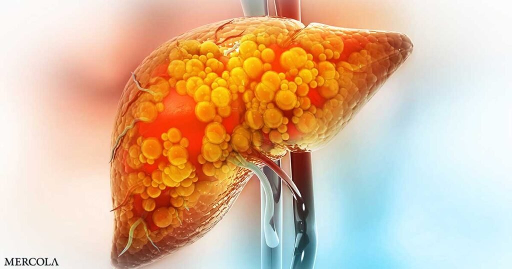 Developing a Fatty Liver Increases Your Risk of Mortality