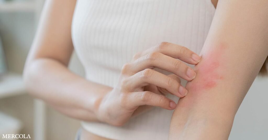 Getting Down to the Root Cause of Hives