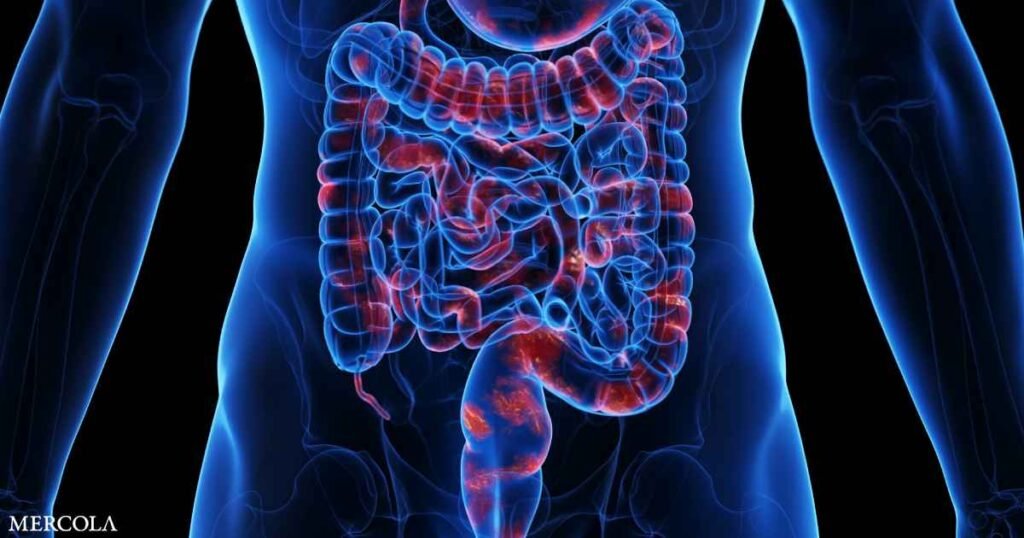 How Ultraprocessed Foods Increase Your Crohn’s Disease Risk